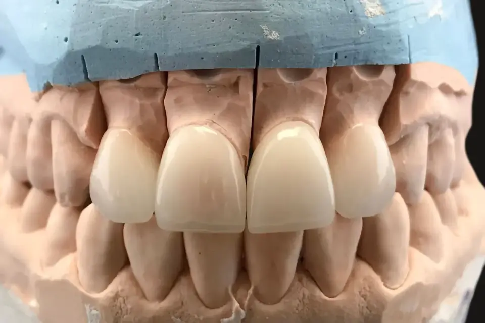 dental gypsum model in dentist laboratory office 2023 11 27 05 02 34 utc